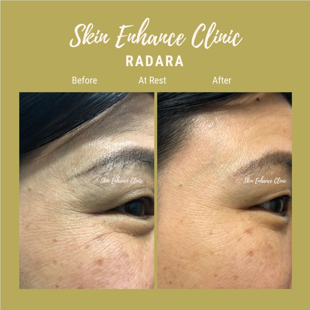 Radara eye home treatment patches