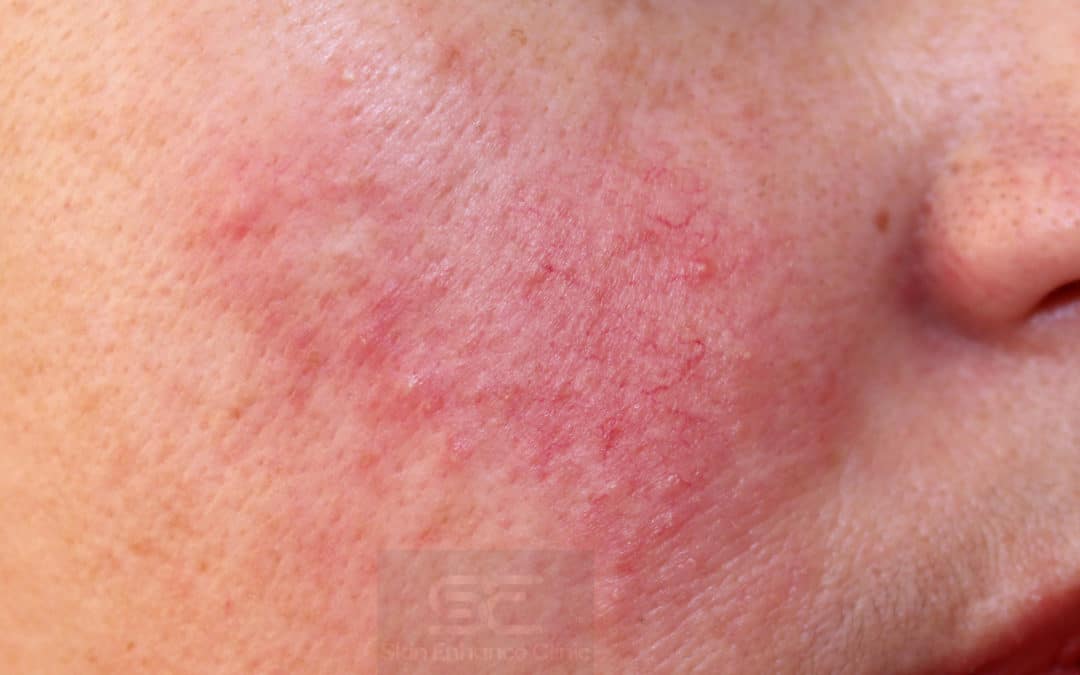 Could the sensitivity on your face be Rosacea