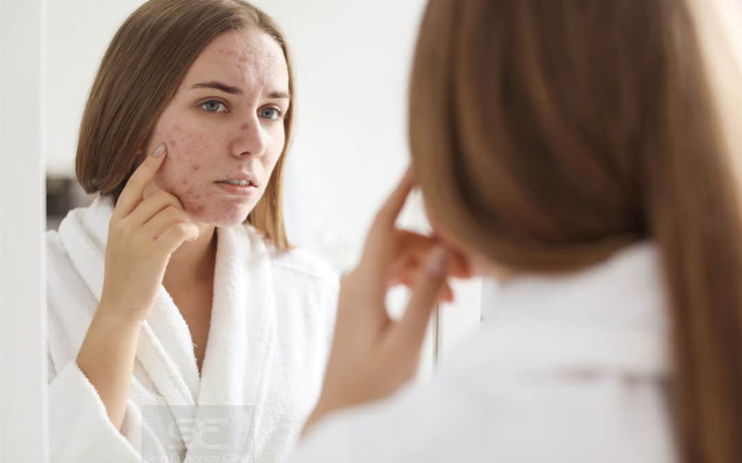 Acne: The unexpected, uninvited, unwanted pain in the face!