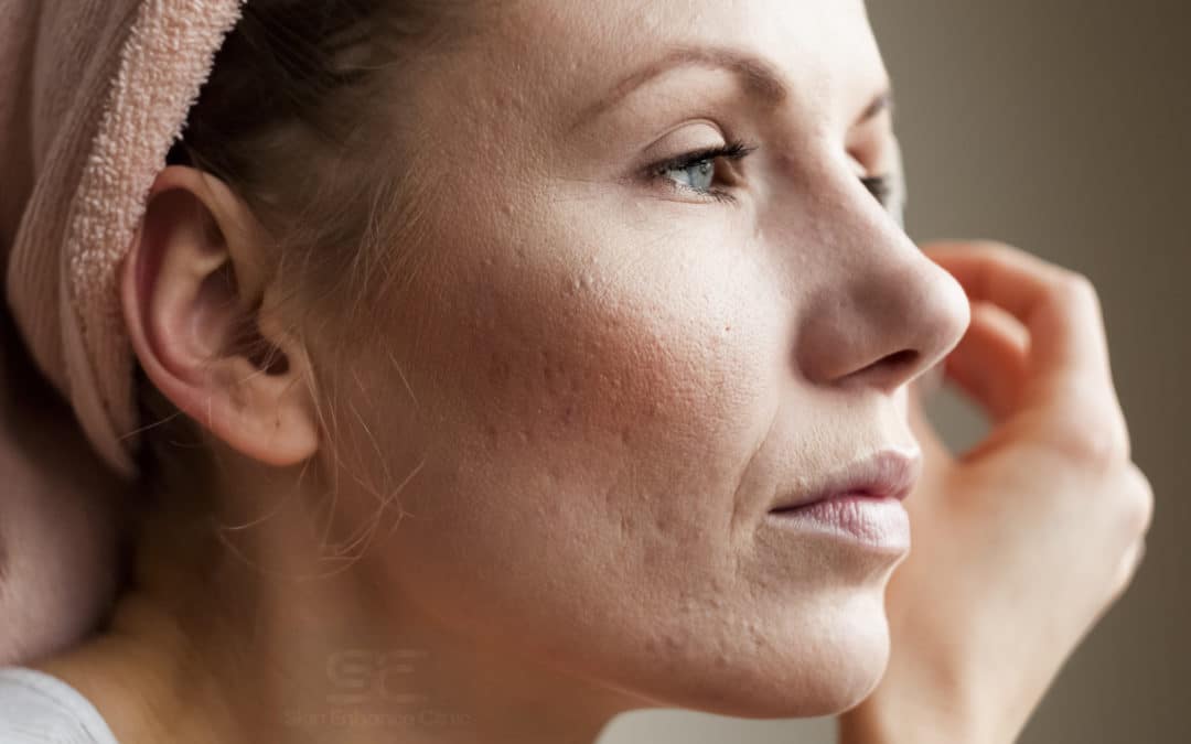 Dr Tash Blogs acne scars