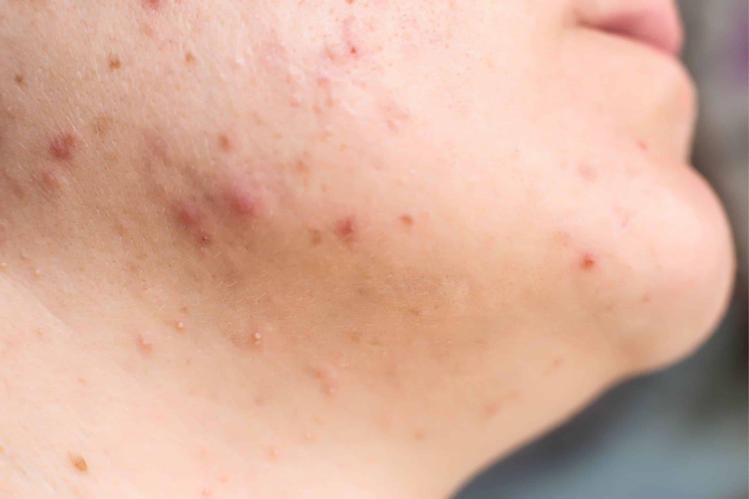 Menopausal acne