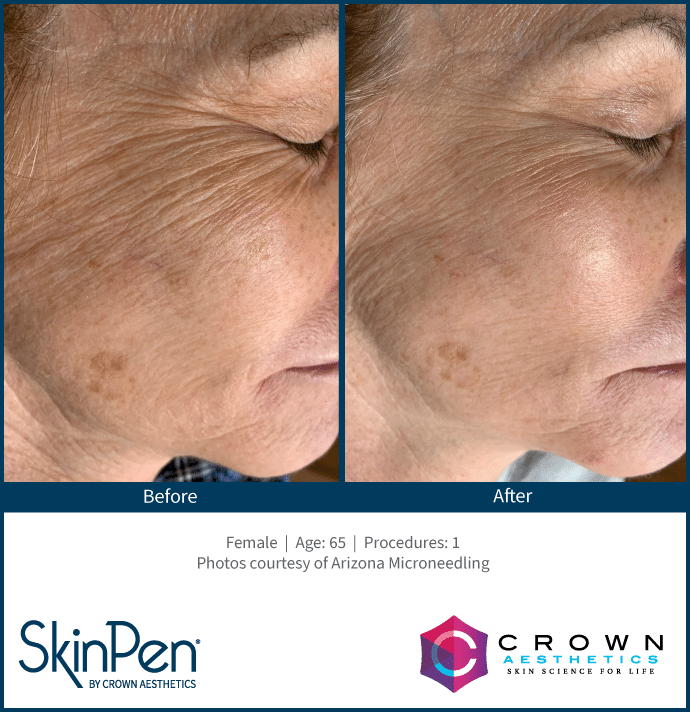 before and after skinpen microneedling